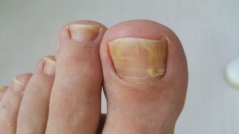 grzybica-choroba-objawy