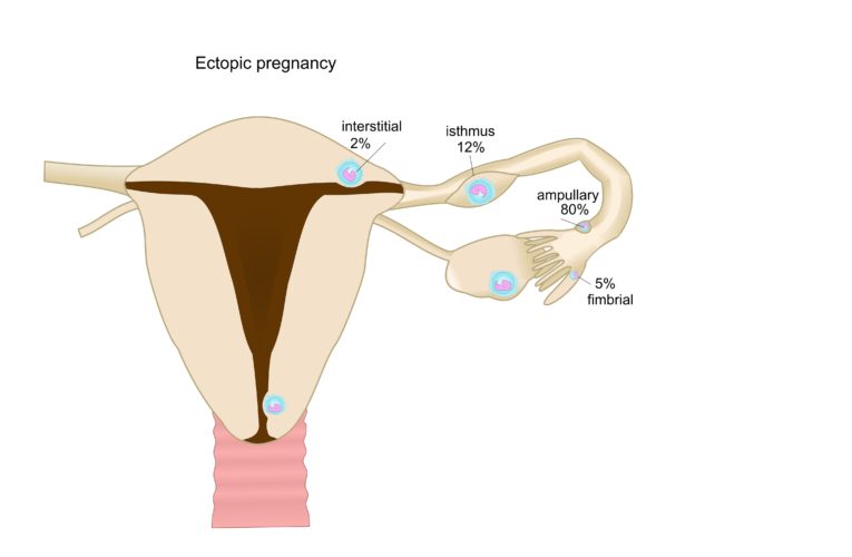 Ciąża pozamaciczna – czym jest? Kiedy do niej dochodzi? Jakie ryzyko się z nią wiąże? 